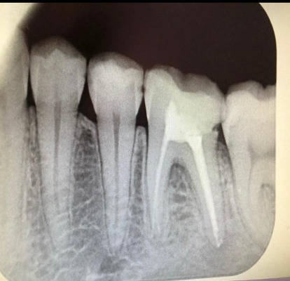root canal treatment abu dhabi