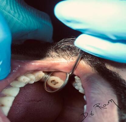 root canal treatment in mussafah